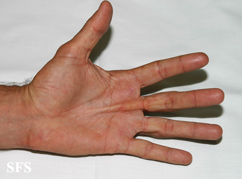 Dupuytren contracture. Adapted from Dermatology Atlas.[1]