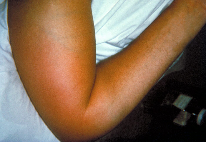 Right elbow of a patient with group B Streptococcus (GBS) bacteremia, with localized edema and erythema. From Public Health Image Library (PHIL). [1]