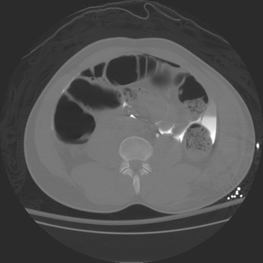 File:Intraperitoneal-bladder-rupture-003.jpg