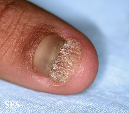 Onychomycosis. With permission from Dermatology Atlas.[5]