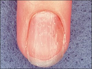 Psoriasis nail pitting[5]