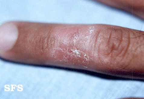 Woringer kolopp disease. Adapted from Dermatology Atlas.[3]