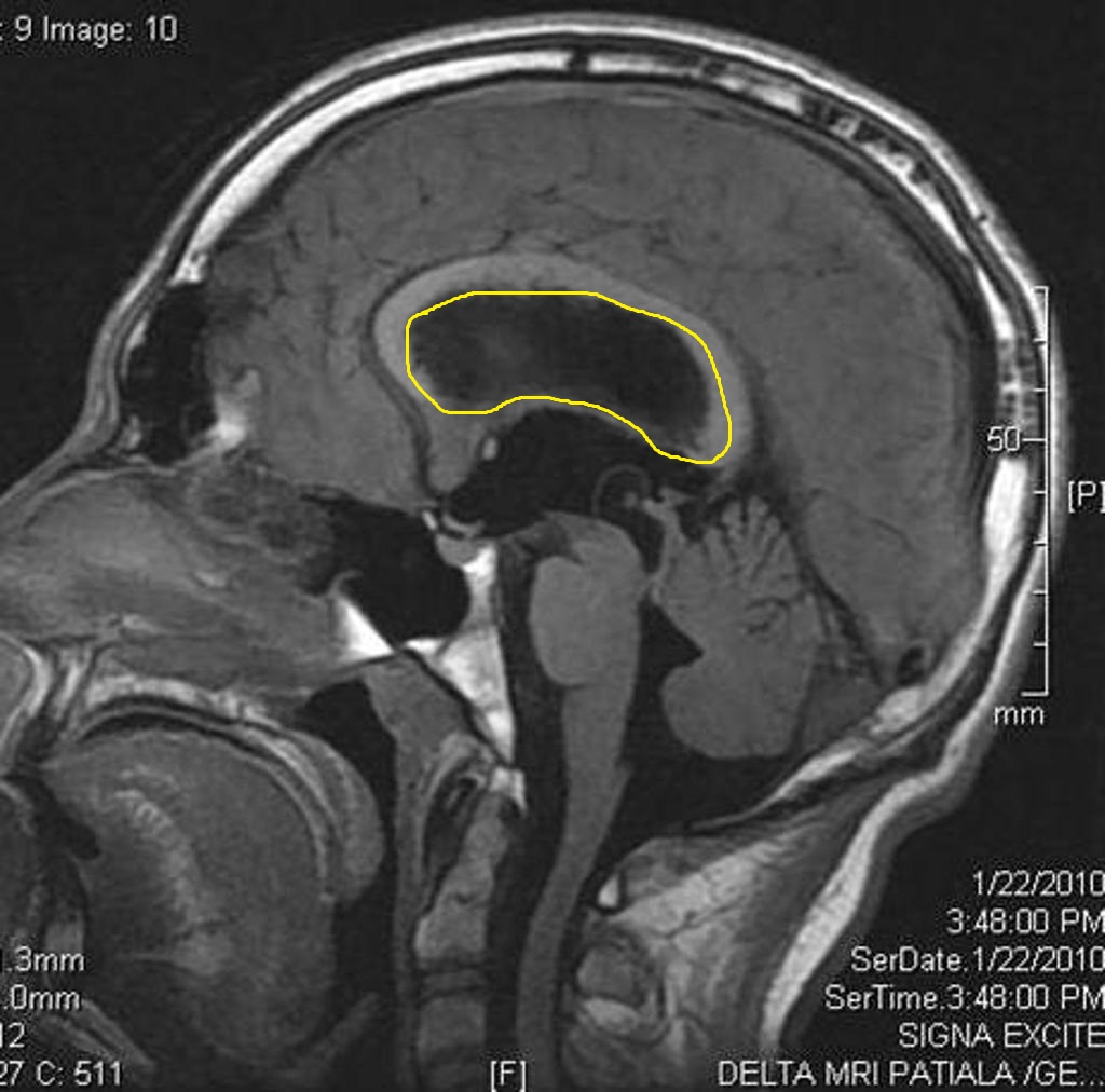 File:Intraventricular-neurocysticercosis-resulting-in-acute-hydrocephalus 1 (1).jpg