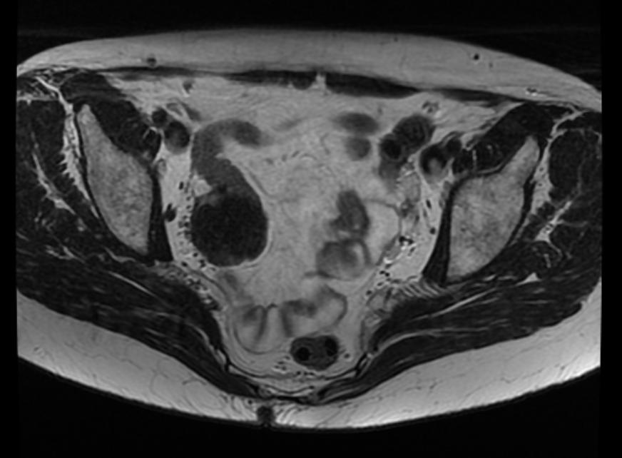 File:Ovarian fibroma MRI 004.jpg