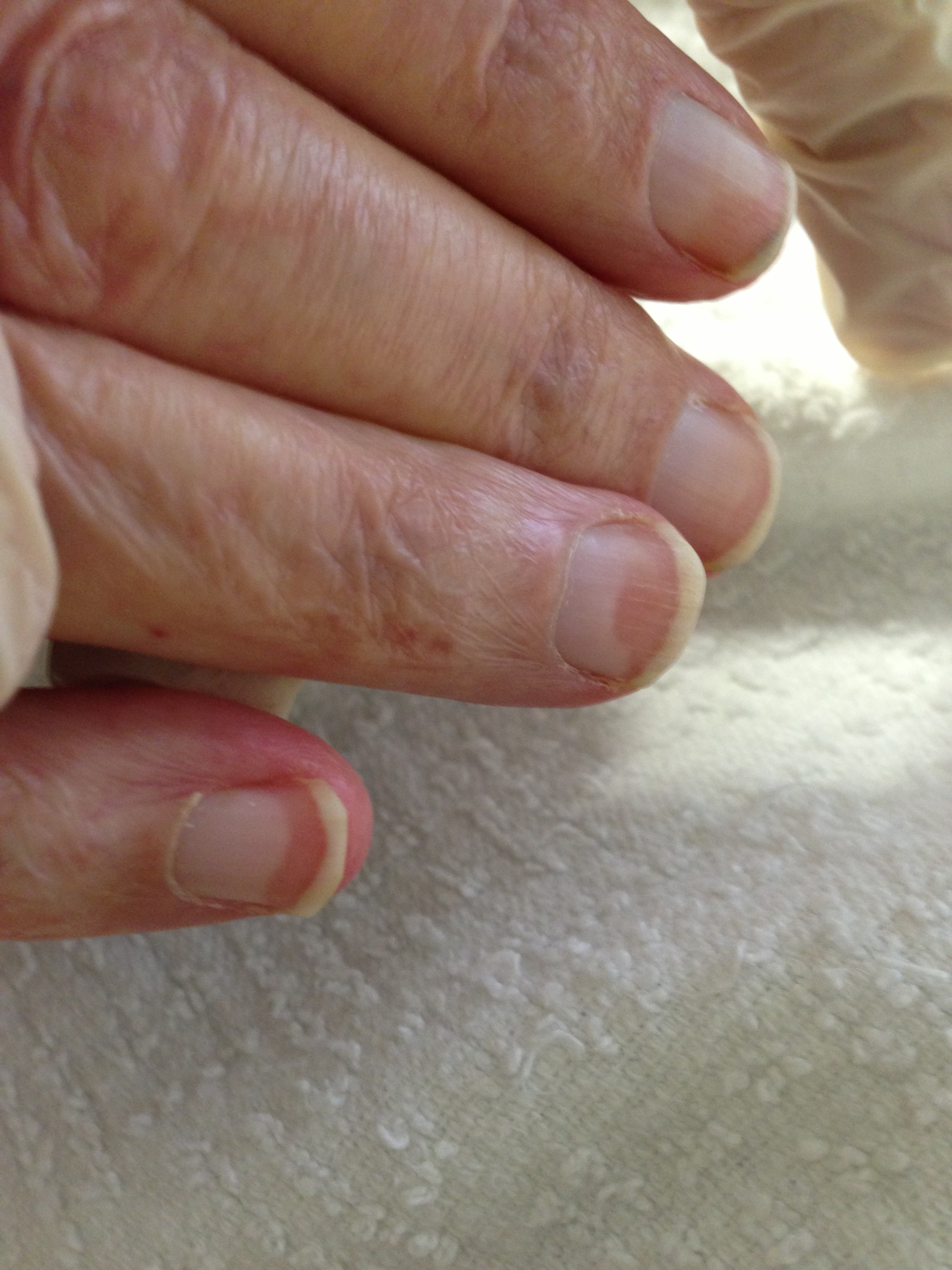 Terry's nails: characteristic "ground glass" appearance, with no lunula.