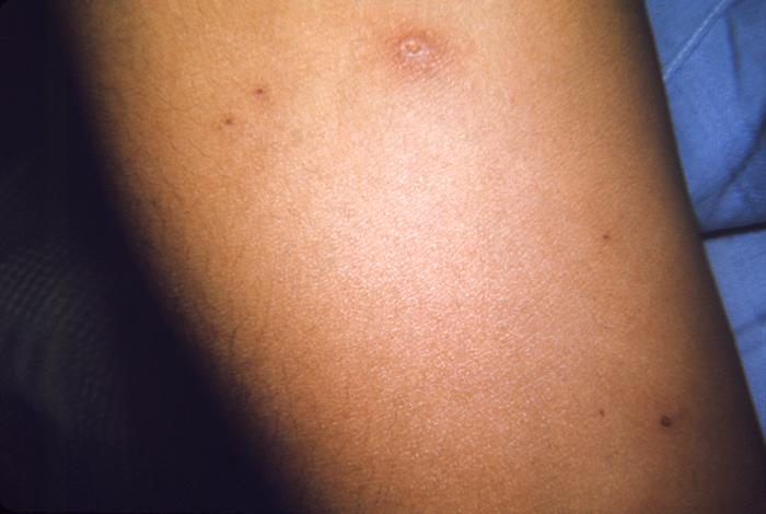 Case of chickenpox. From Public Health Image Library (PHIL). [24]
