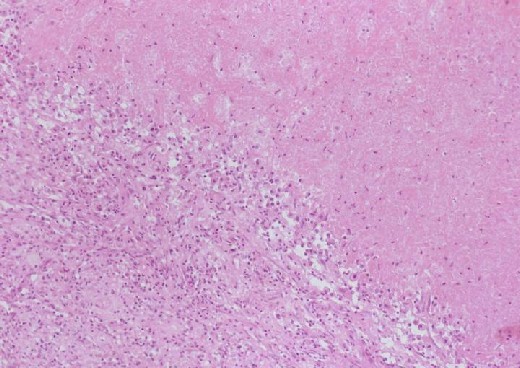 Inflammatory cells seated on the margin of infarct area