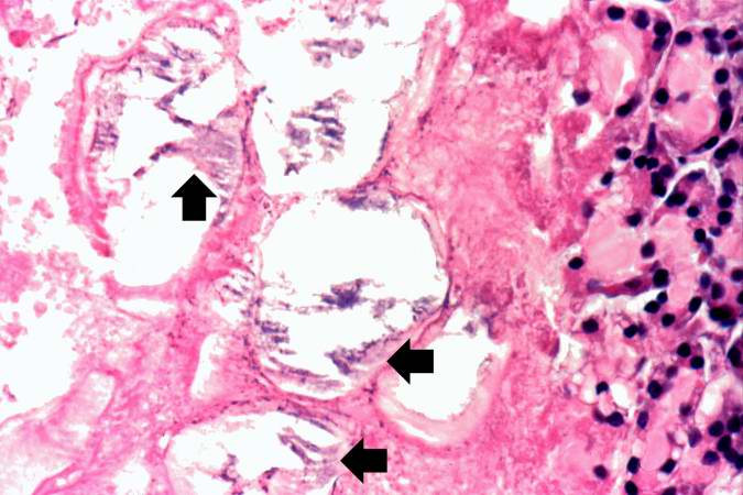 This is another high-power photomicrograph demonstrating the calcification (arrows) seen in fat necrosis involving the interlobular spaces of the pancreas.