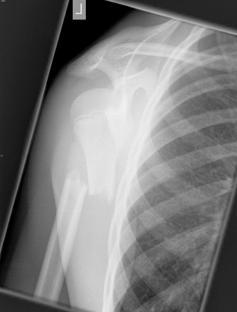 File:Proximal-l-fracture-in-child (1).jpg