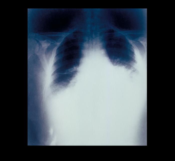 This anteroposterior (AP) chest radiograph showed a widened mediastinum due to inhalation anthrax, and was taken 22 hours before death. Adapted from Public Health Image Library (PHIL), Centers for Disease Control and Prevention.[2]