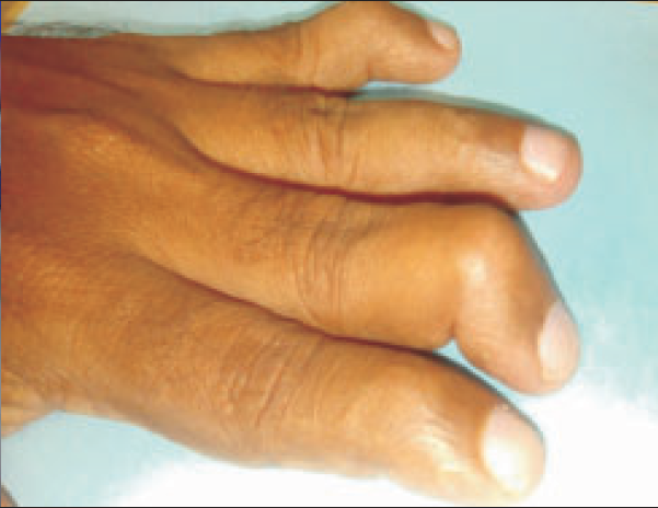 Arthritis in left hand