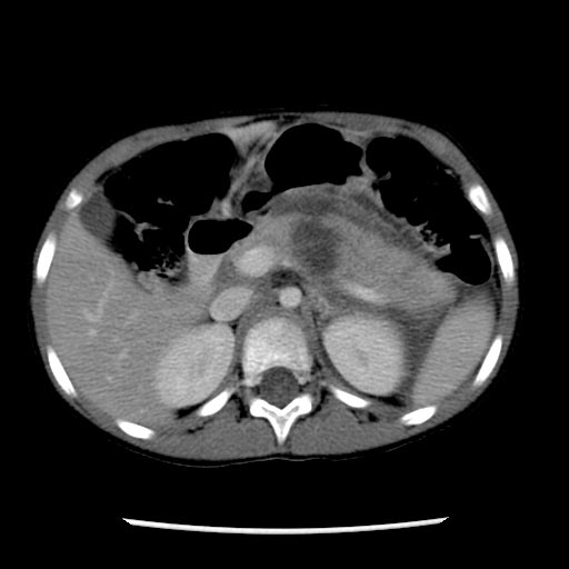 Computed Tomography, Pancreatic laceration: A patient with pancreatic transection and pseudocyst formation from motor vehicle accident