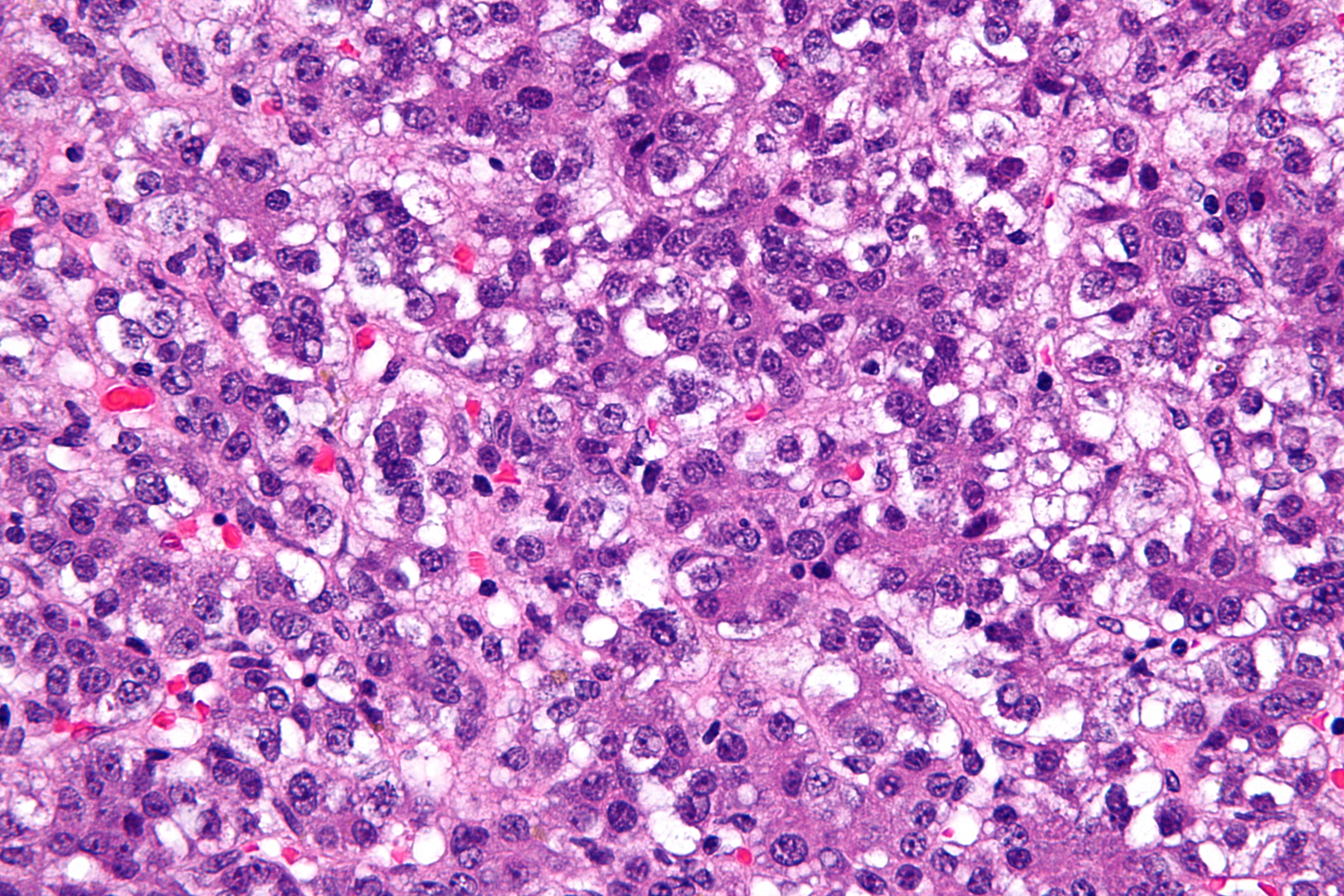 File:Hepatoblastoma.jpg