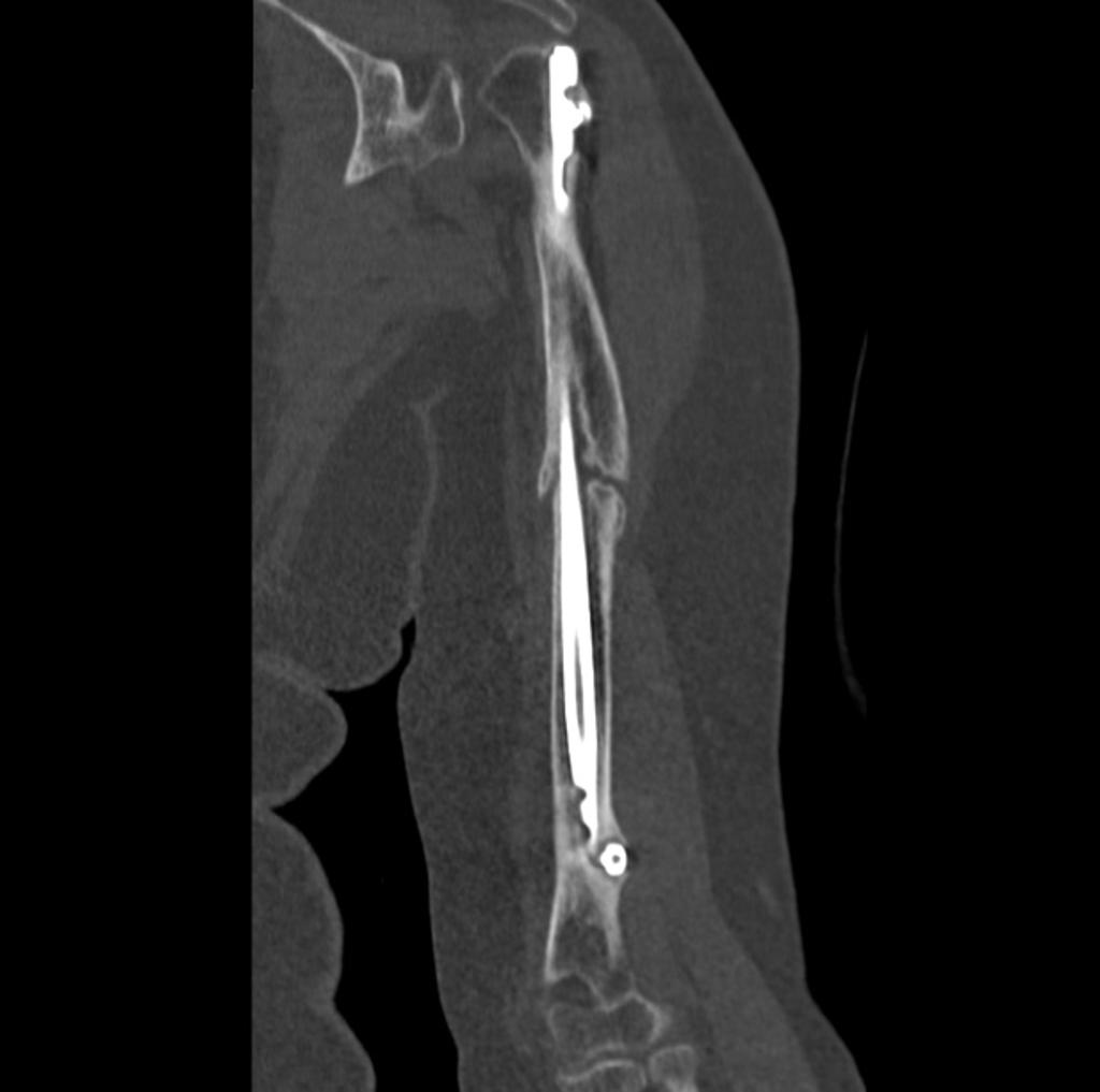 Coronal bone window- Fracture of the middle third of the humerus, with small shifting and no signs of consolidation.