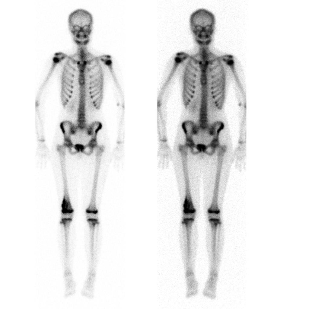 Delayed images of a bone scan demonstrate the femoral lesion to have increased activity. No other lesions evident.