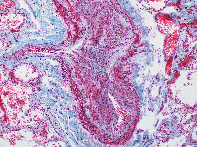 This artery exhibits marked intimal thickening The red-staining cells in the intima are probably myofibroblasts. Masson trichrome stain.