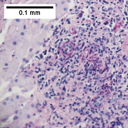 F. PAS with diastase showing neutrophil in bille duct lumen, diagnostic of acute cholangitis.