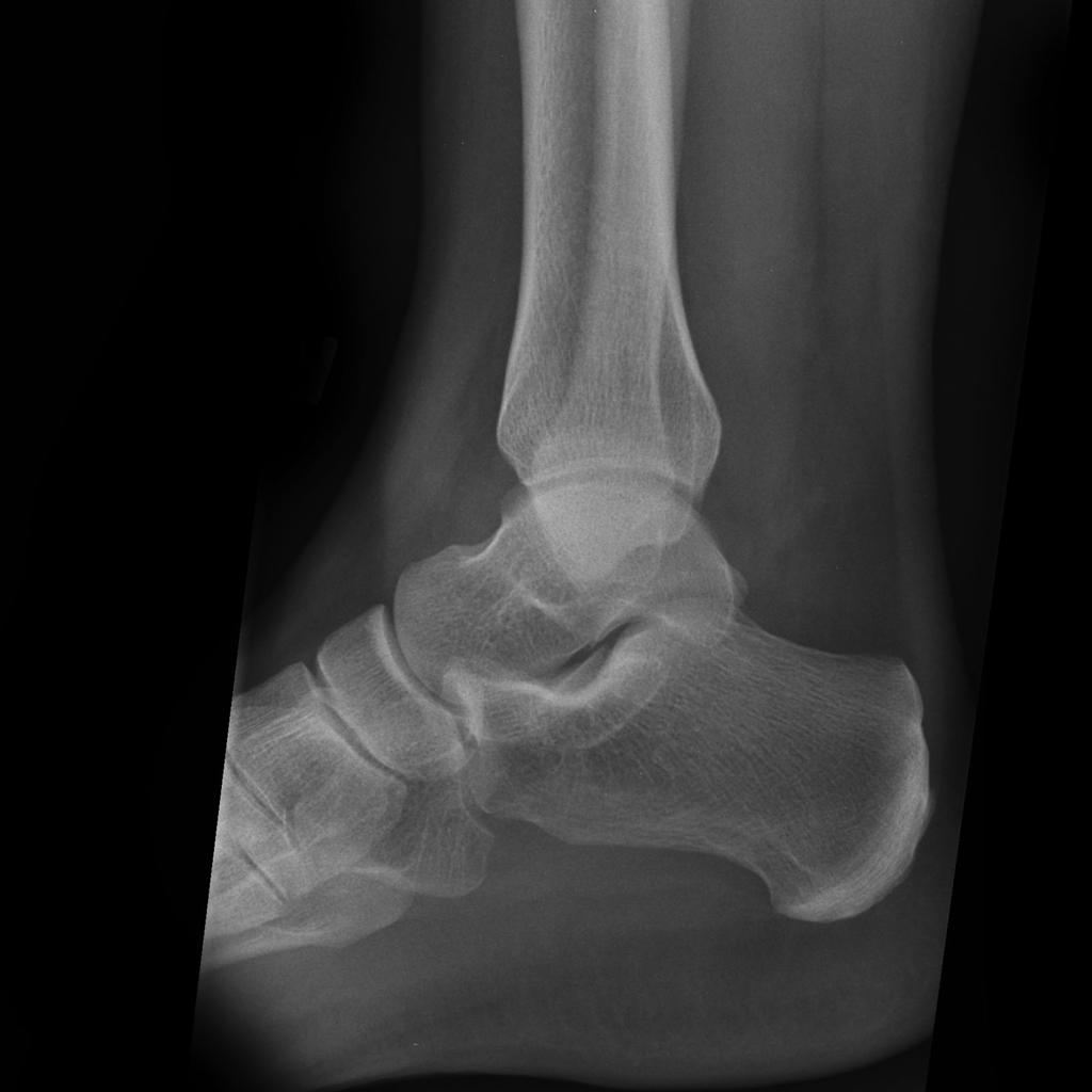 File:Ankle-fracture-weber-a-5 (1).jpg