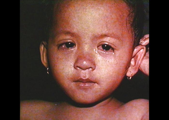 Conjunctivitis (pink eye) in a child with measles
