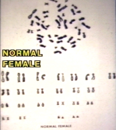 Normal female karyotype.