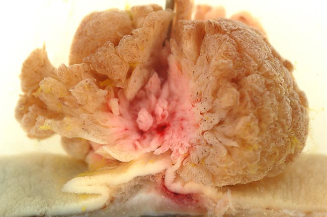 File:Villous adenoma of the sigmoid colon, gross pathology.jpg