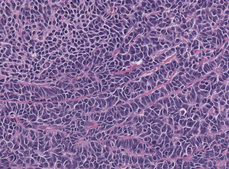 Medulloblastoma demonstrating epitheloid ribboning and nuclear moulding of tumor cells[2]