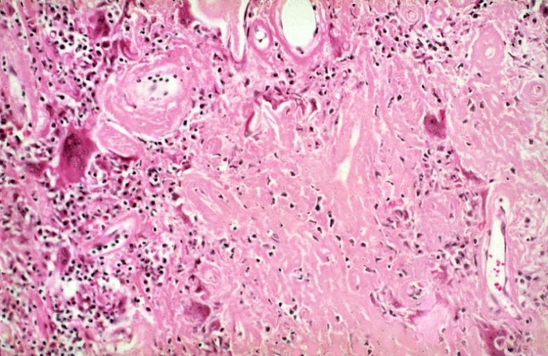NODULAR PARENCHYMAL AMYLOIDOSIS: Lower Respiratory Tract. The amyloid consists of solid masses and bands of amorphous, eosinophilic, extracellular material. A multinucleated giant cell reaction is present, a typical finding in pulmonary amyloidosis.