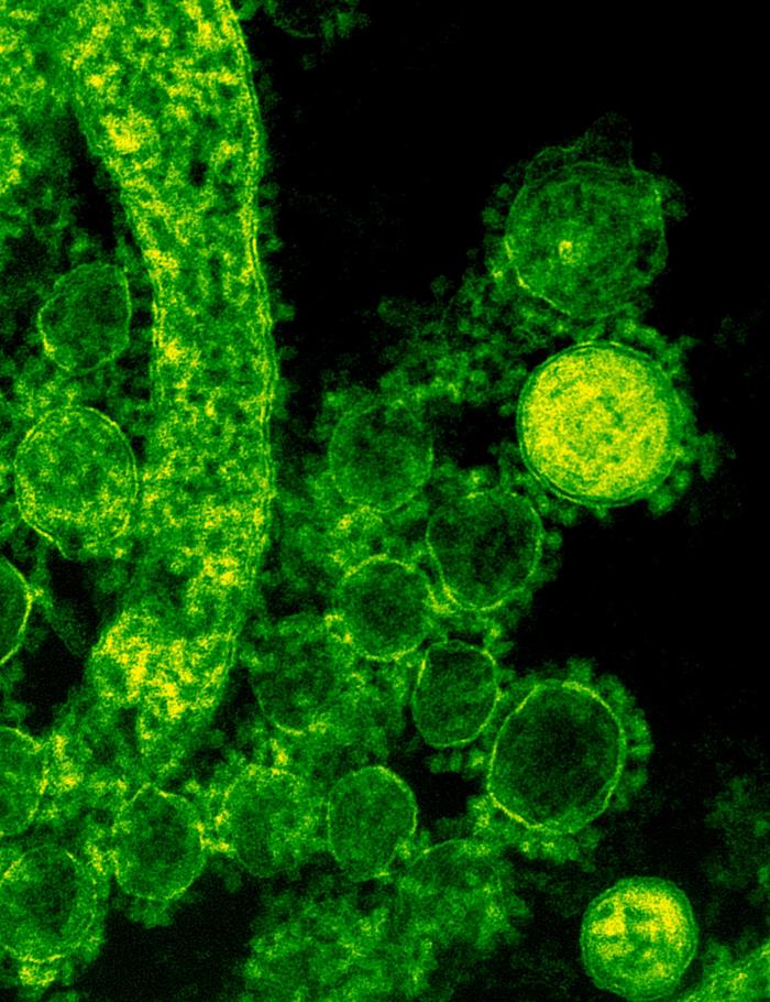 TEM reveals ultrastructural details exhibited by a number of spherical-shaped Middle East Respiratory Syndrome Coronavirus (MERS-CoV) virions. From Public Health Image Library (PHIL). [1]