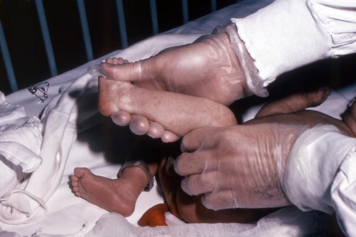Left lower extremity of a 5 week-old male patient who after receiving a smallpox vaccination, developed an erythema multiforme reaction. Note how the maculopapular rash had spread to his left, lower extremity.Adapted from Public Health Image Library (PHIL), Centers for Disease Control and Prevention.[14]