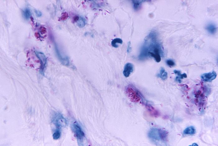 Light photomicrograph revealing some of the histopathologic cytoarchitectural characteristics seen in a mycobacterial skin infection Adapted from Public Health Image Library (PHIL), Centers for Disease Control and Prevention.[26]