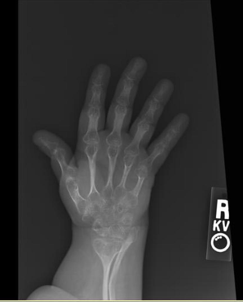 Juvenile osteoporosis in osteogenesis imperfecta, Via: Radiopaedia.org[10]