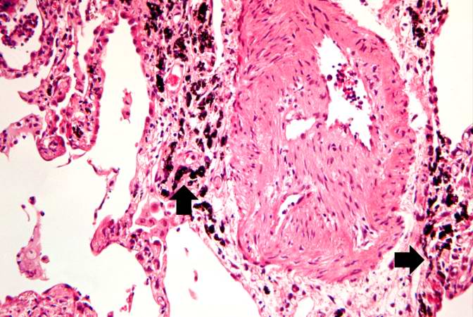 This is a high-power photomicrograph of a recanalized blood vessel in the lung. Notice the anthracotic pigment adjacent to the vessel (arrows).