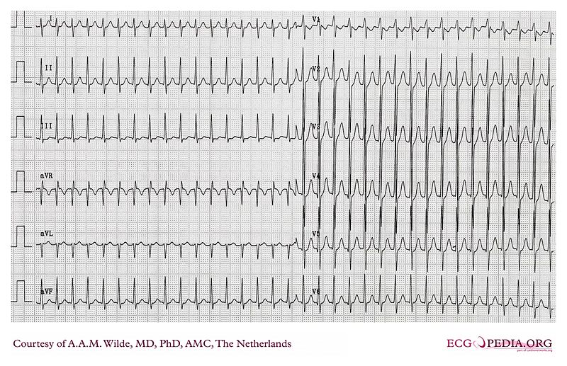 EKG shows supraventricular tachycardia, source: courtesy of ECGpedia, http://en.ecgpedia.org/wiki/File:De-AW00011.jpg