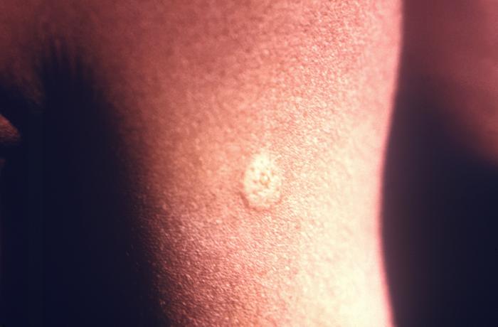 Upper arm revealing the site of a newly-administered smallpox vaccination, which had been performed using a “Ped-O-Jet®” jet injector. Notice the wheal type morphology of the vaccination site.Adapted from Public Health Image Library (PHIL), Centers for Disease Control and Prevention.[3]