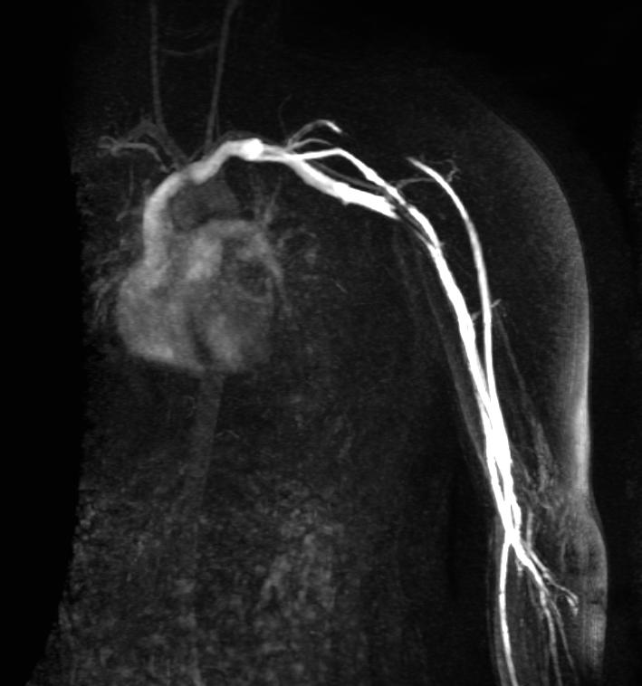 File:Thoracic outlet syndrome MRI 003.jpg