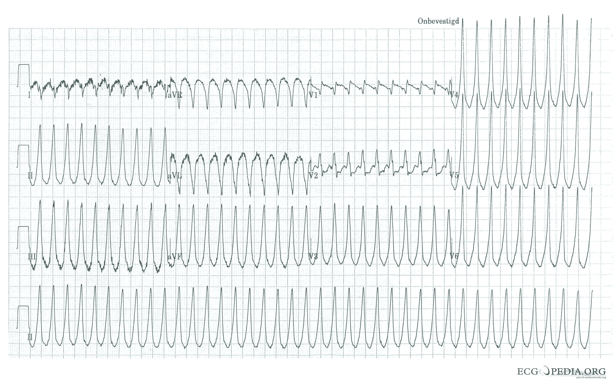 Ventricular tachycardia of 250 bpm with a right bundle branch block pattern and right heart axis.