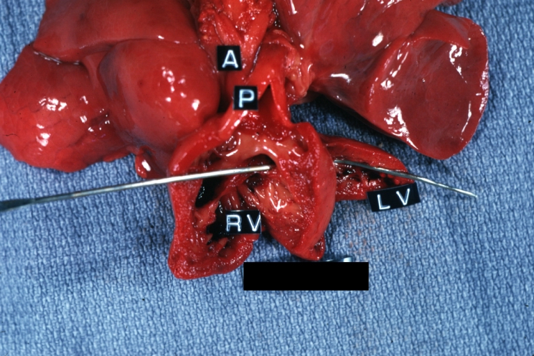 Atrioventricular Canal: Gross infant heart (well shown)