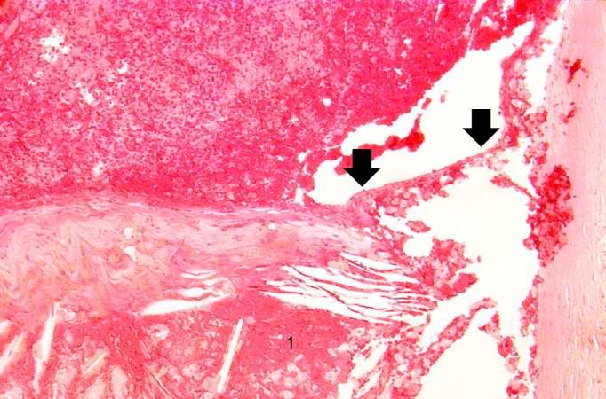 This is another high-power photomicrograph of the ruptured fibrous cap (arrows) with hemorrhage (1) into the atherosclerotic plaque. Note the presence of cholesterol crystals.
