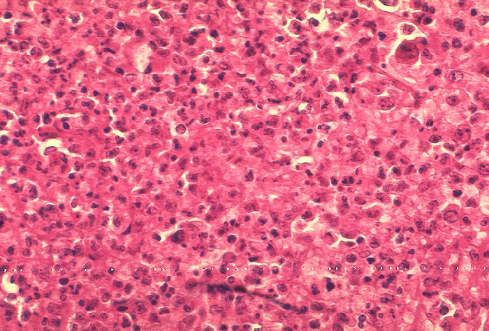 "Histopathology of mediastinal lymph node in fatal human anthrax” Adapted from Public Health Image Library (PHIL), Centers for Disease Control and Prevention.[21]
