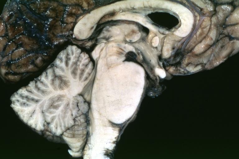 Brain: Pontine Glioma: Gross; fixed tissue, sagittal section brain stem and cerebellum