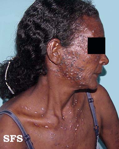 Lupus erythematosus chronicus disseminatus superficialis. Adapted from Dermatology Atlas.[6]