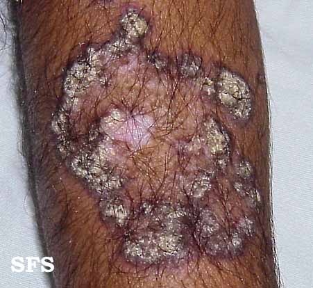 Lupus erythematosus chronicus verrucous. Adapted from Dermatology Atlas.[4]