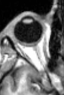 MRI scan of human eye showing lens.