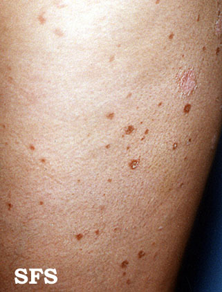 Pityriasis lichenoides chronica. Adapted from Dermatology Atlas.[1]