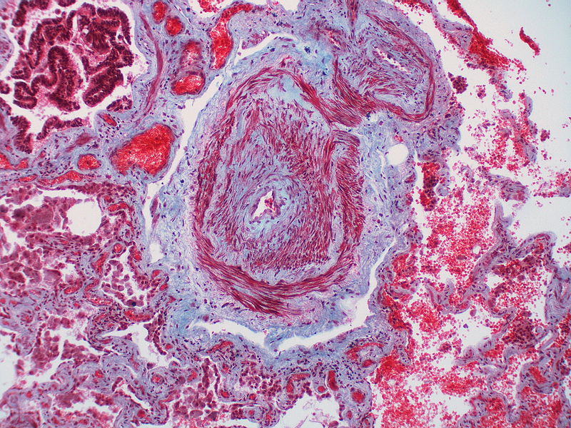 This artery exhibits marked intimal thickening as well as adventitial thickening. The red-staining cells in the intima are probably myofibroblasts. Masson trichrome stain.
