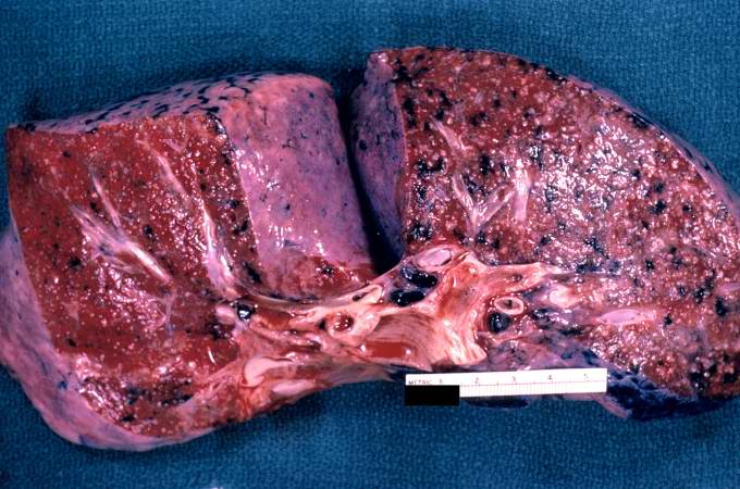 A gross photograph of a cut section of lung from this patient with disseminated tuberculosis. The numerous small white nodules scattered throughout this lung tissue represent individual tuberculosis granulomas. In addition, note the dark areas throughout the lung which represent deposits of anthracotic pigment.