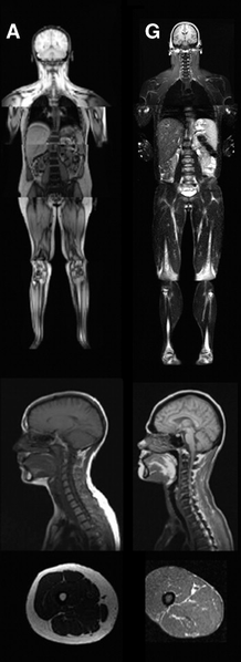 File:Congenital Generalized Lipodystrophy MRI.png