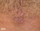 Folliculitis Cheloidalis. Used with permission of Dermatology Atlas