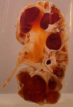 Specimen of a kidney that has undergone extensive dilation due to hydronephrosis. Note the extensive atrophy and thinning of the renal cortex.