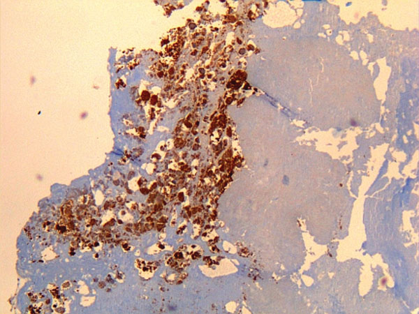 File:Immunohistochemical detection of Coxiella burnetii in resected cardiac valve of a 60-year-old man with Q fever endocarditis.jpg